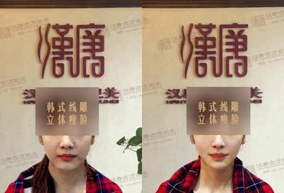 【重庆韩式线雕立体瘦脸案例 周女士成功瘦脸 】价格,厂家,美容美发服务-搜了网